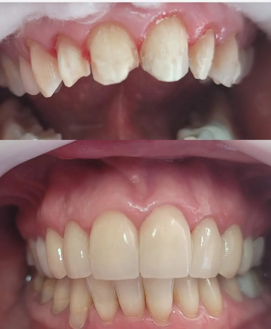 Reabilitação Estética
